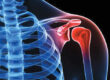 rotator cuff injury