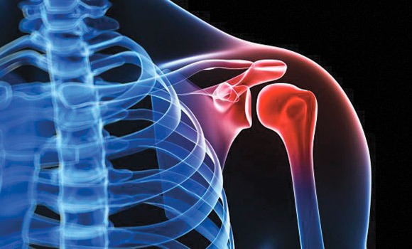 rotator cuff injury